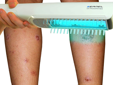 Zakup lampy do fototerapii w warunkach domowych Kernel UVB 311nm KN-4003BL2D (bezprzewodowa)
